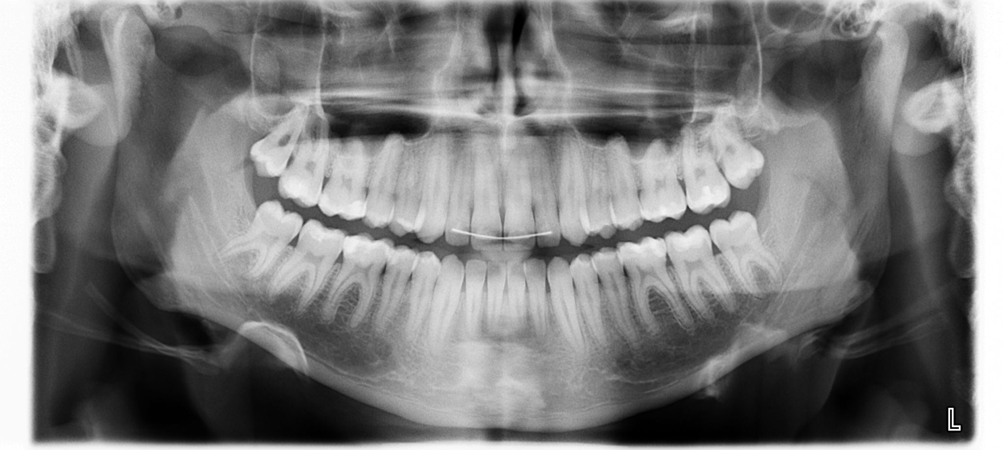 Ortopantomografia-x-radiografia-digitale